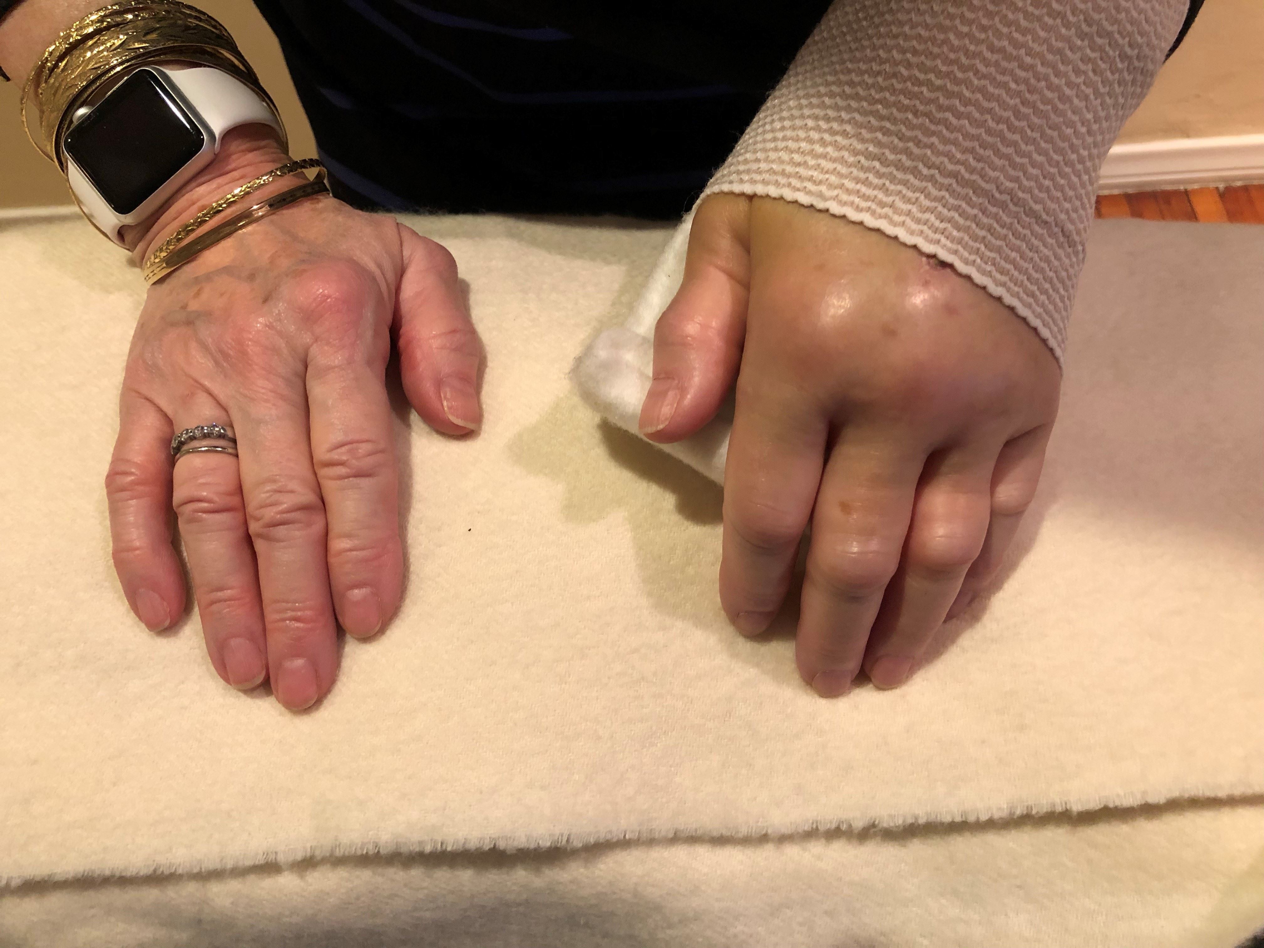 woman's swollen left hand due to a broken wrist